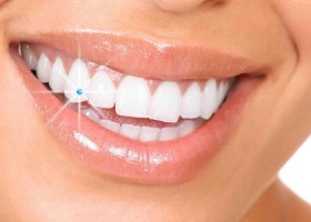 lingual braces