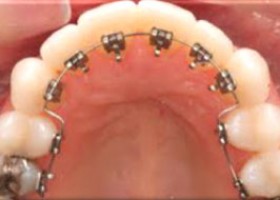 lingual braces