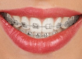 metalic braces