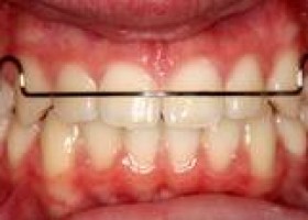 removable appliances