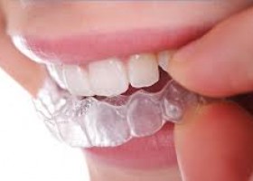 Invisalign