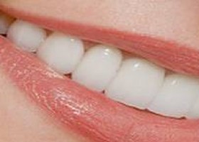 teeth whitening