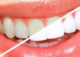 teeth whitening