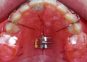 removable appliances